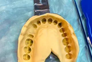 Dolgu Sonrası Yükseklik Hissi ve Çiğneme Rahatsızlığı Ne Anlatabilir?