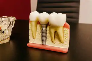 How Are Implant and Prosthetic Planning Considered Together in Ankara?