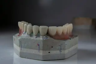 Ankara’da İmplant ve Protez Planlaması Birlikte Nasıl Düşünülür?