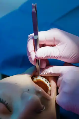 Sabah Çene Ağrısı ve Diş Sıkma Bulguları Nasıl Değerlendirilir?